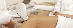 Ellipse IPL Hair Removal